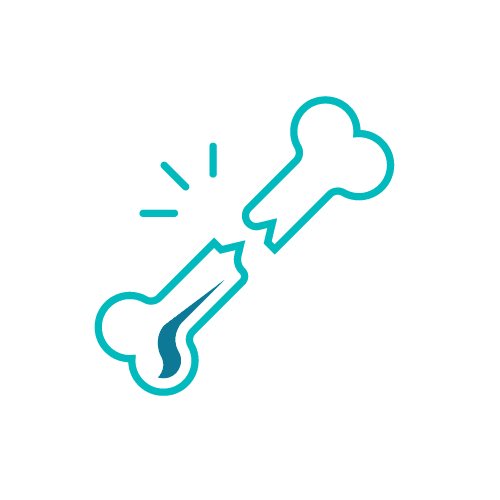 Orthopedic illustration of a broken bone with a crack and stress lines, symbolizing fracture or injury in turquoise color.